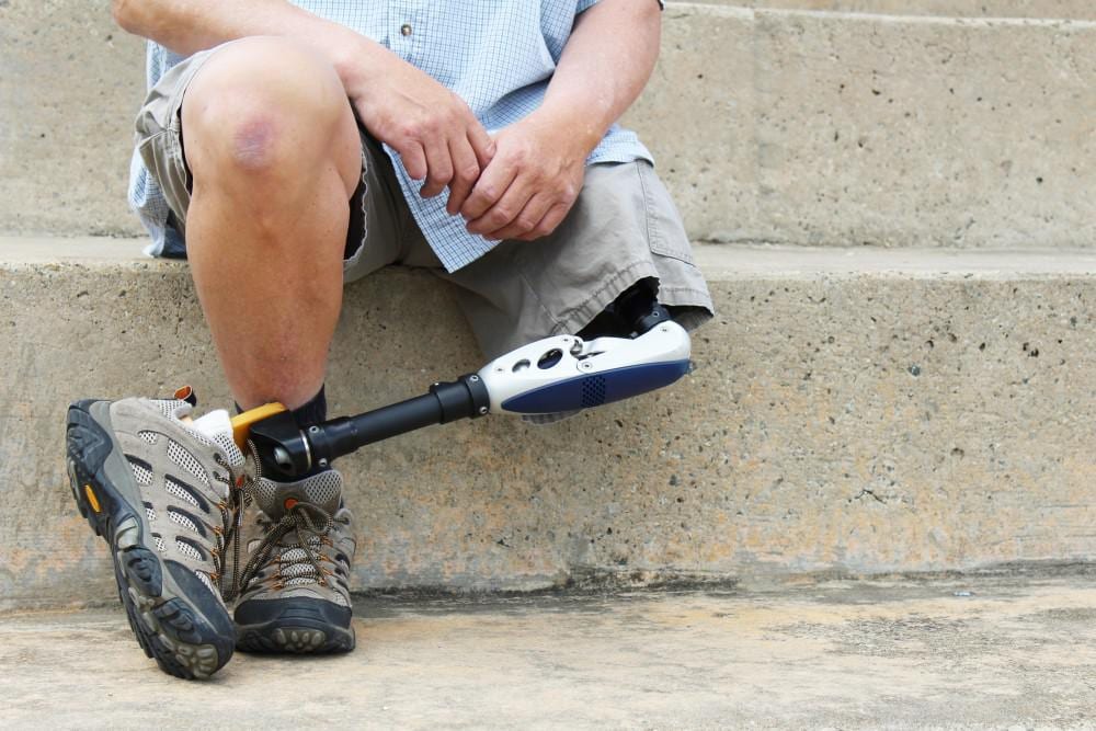 What to Do About Phantom Limb Pain After Amputation